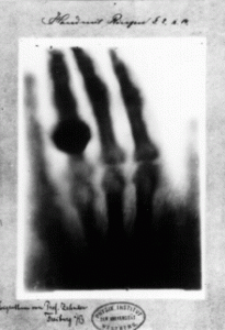 X-Ray of hand